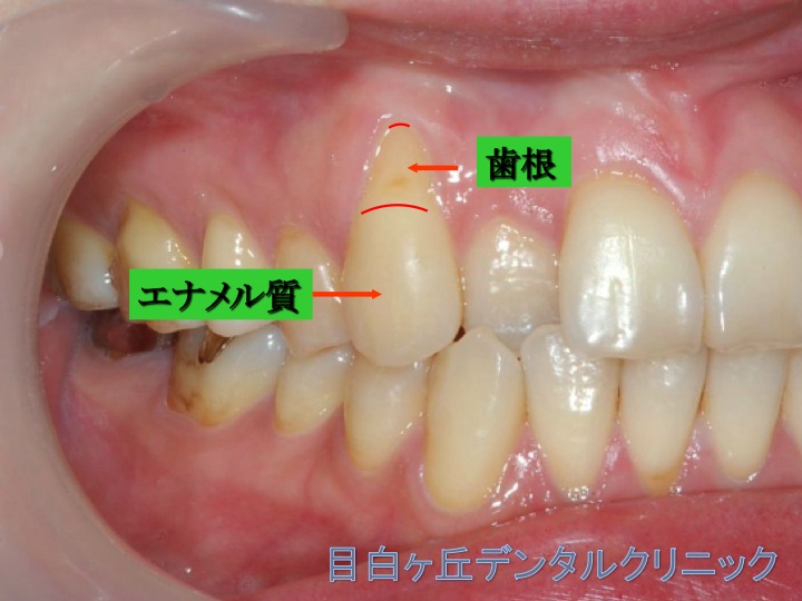 Fig.4 歯肉退縮