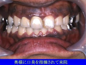 歯茎の色3