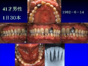 歯茎の色1